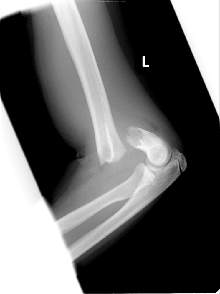 Elbow X Ray Fracture